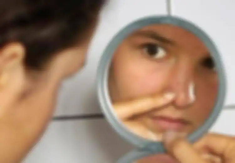 Obat Jerawat yang Ampuh, Adakah?