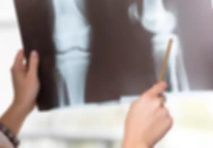 Inilah Empat Makanan yang Bisa Memicu Arthritis Jadi Lebih Buruk