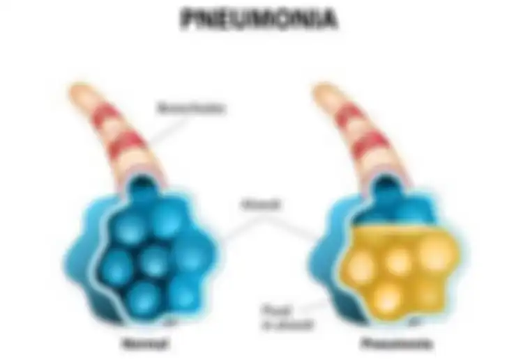 Penyebab Orang Tua Sering Diserang Pneumonia