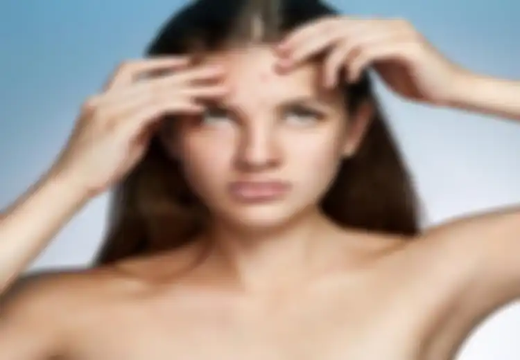 5 Cara Ampuh Hilangkan Jerawat Lewat Bahan-bahan Alami di Sekitar Kita