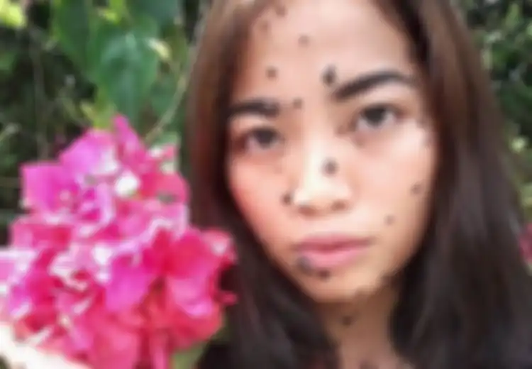 Meski Dijuluki Monster Gara-gara Tubuhnya Dipenuhi Tahi Lalat, Gadis Ini Tetap ‘Pede’ Ikut Audisi Miss Universe