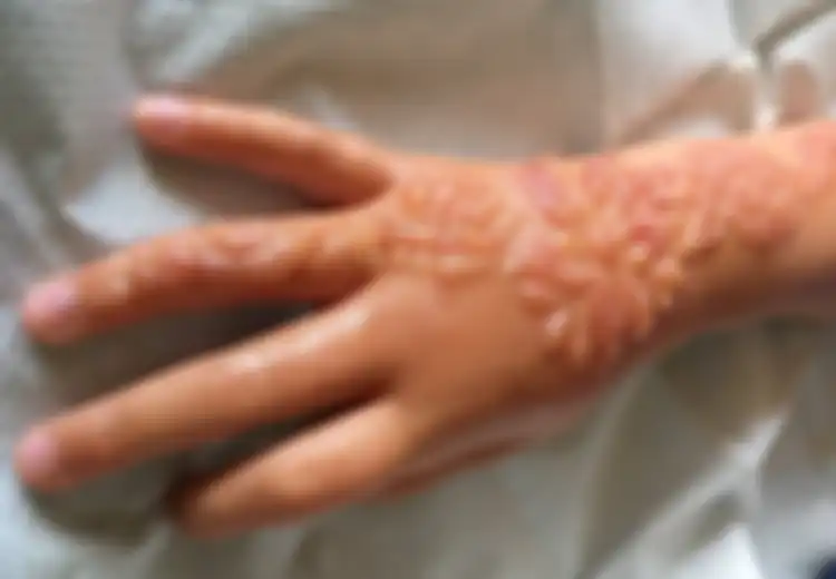 Jangan Sampai Anak Gadis Anda Menderita Seperti Ini Gara-gara Henna