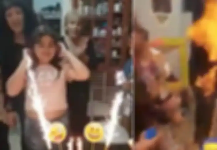Mengerikan, Anak Perempuan Ini Terbakar Saat Meniup Lilin di Kue Ulang Tahunnya