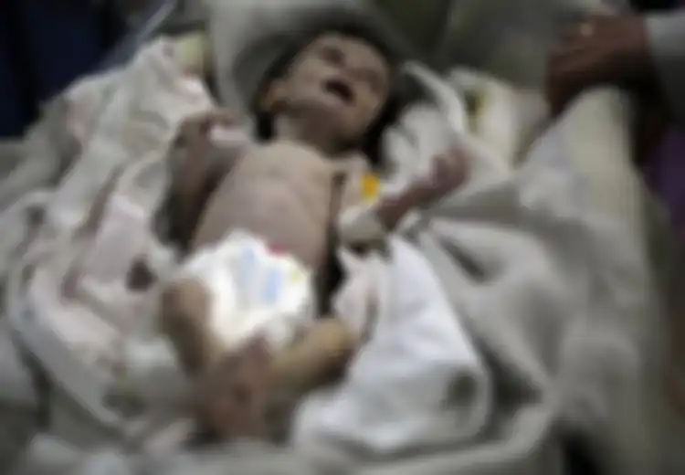 Menyedihkan, Gara-gara Perang, Bayi Tak Berdosa Ini Harus Mati Mengenaskan Akibat Gizi Buruk