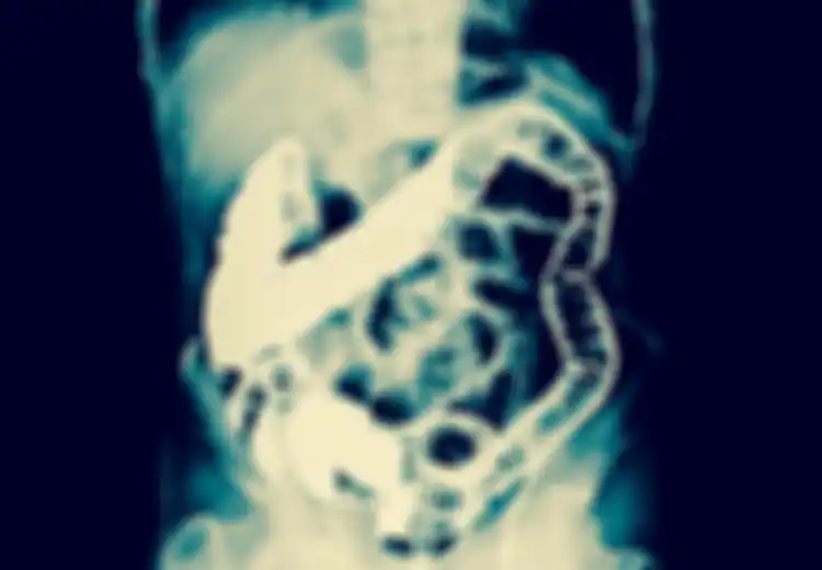Wow, Dokter Keluarkan Kotoran Padat Seberat 12 Kg dari Tubuh Seorang Pria, Ini Penjelasan Ilmiahnya