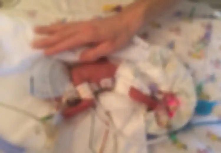 Lahir Prematur 23 Minggu, Bayi Mungil dengan Berat Hanya 0,5 Kg Ini Berhasil Selamat!