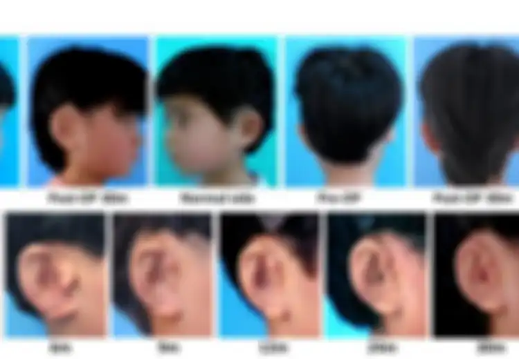 Ilmuwan China Dapat Menumbuhkan Telinga Baru untuk Anak-anak yang Lahir Cacat Pendengaran