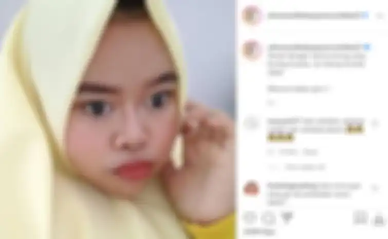 Kekeyi setelah melakukan filler hidung