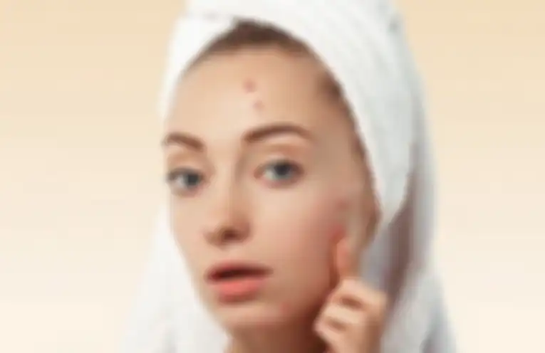 Wajah berjerawat