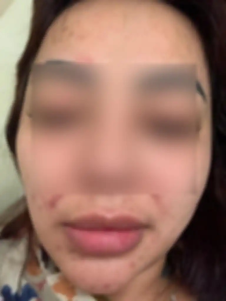Nadia Christina menunjukkan wajahnya lebam, yang disebutnya karena ulah Alfath Fathier. 