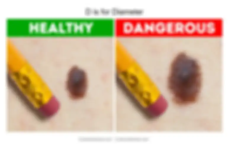 diameter atau ukuran tahi lalat