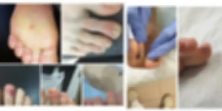 Lesi di kaki yang dilaporkan sebagai gejala baru virus corona yang telah muncul di beberapa negara.