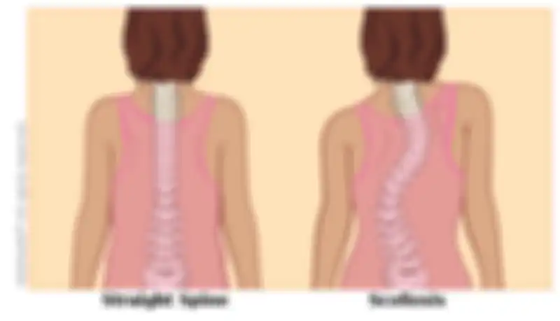 Kondisi tulang yang lurus dan kondisi tulang pada penderita skoliosis