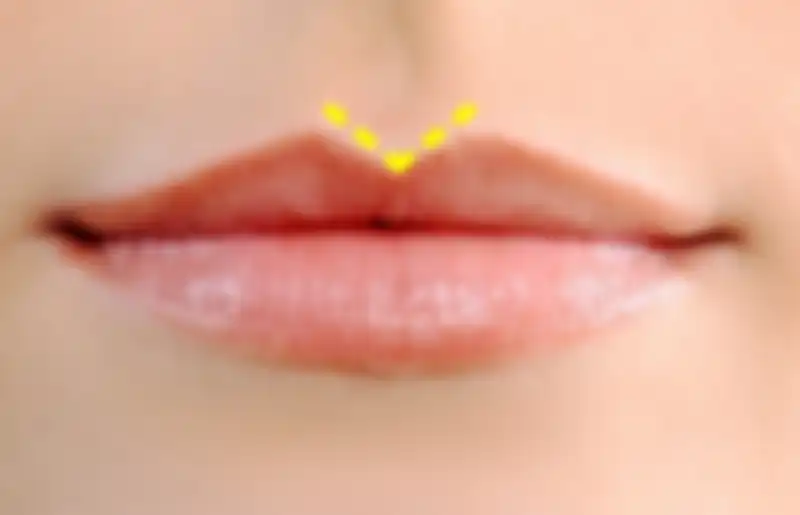 Peaked Cupid’s Bow
