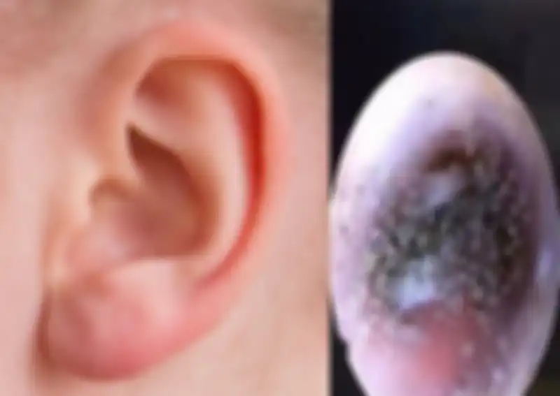 Saluran Telinga Berjamur Karena Keseringan Memakai Earphone