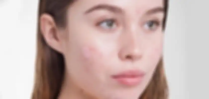 kulit berjerawat