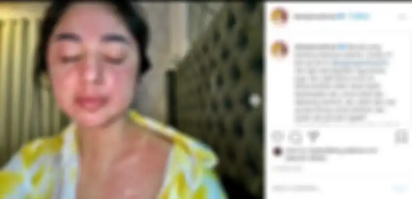 Positif covid-19, Dewi Perssik alami gejala tak wajar hingga muncul ruam merah di sekujur tubuhnya