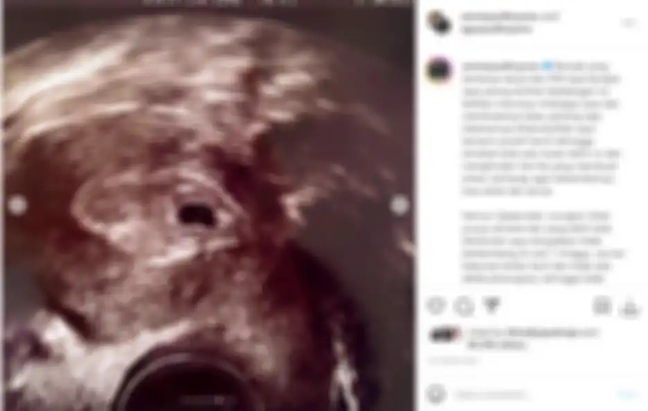Annisa Pohan kehilangan calon anak kedua. 