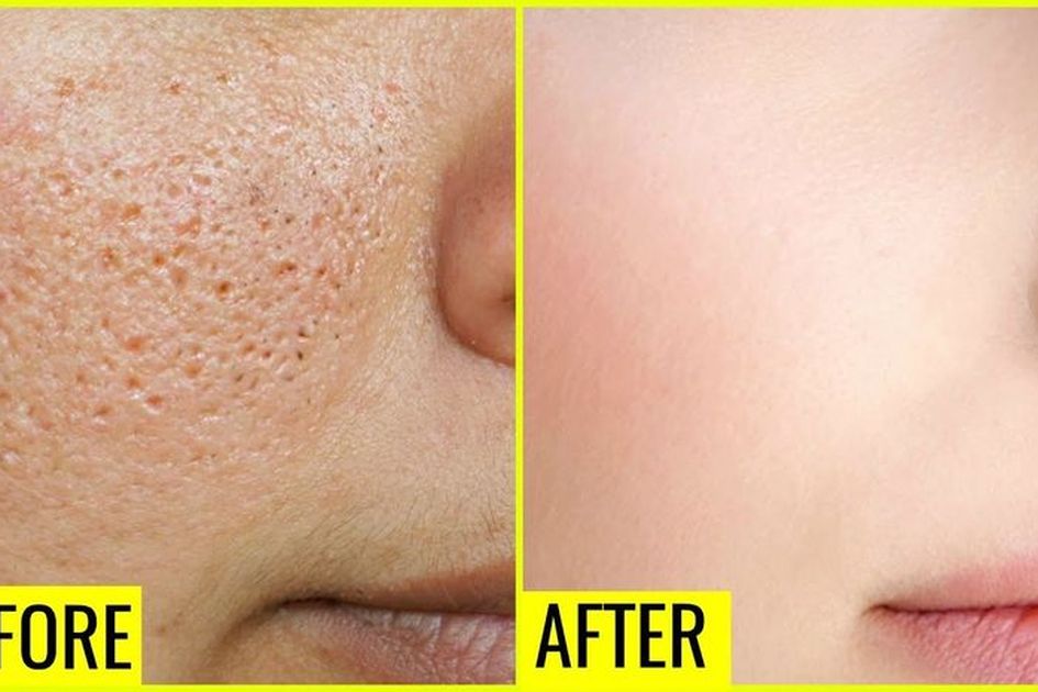 10 Bahan Alami untuk Mengatasi Pori-pori Wajah Besar, Ampuh Bikin Kulit  Tampak Flawless!
