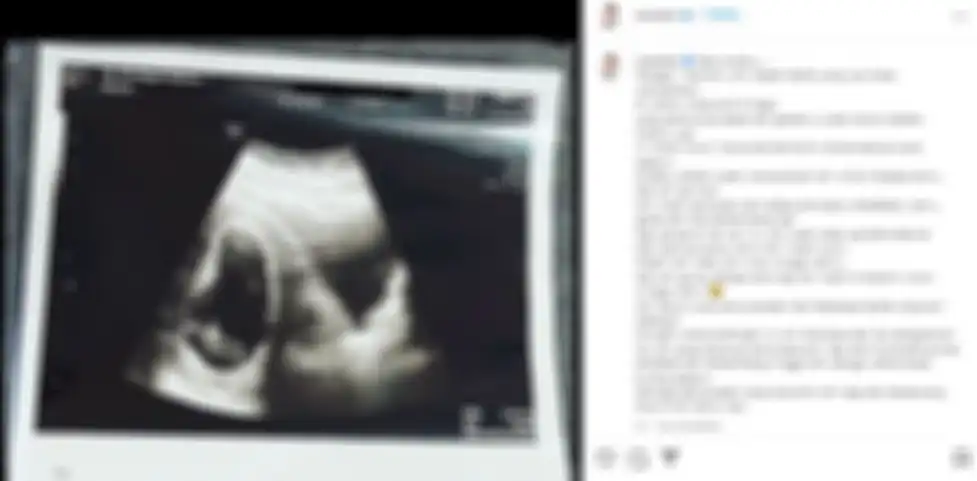 Detak jantung anak Via Vallen tak berdetak, bumil wajib tahu tanda bahaya pada kehamilan
