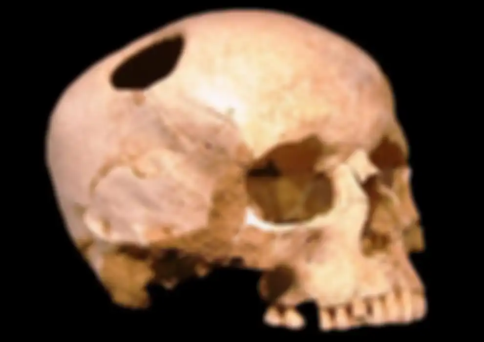 Tengkorak manusia setelah melakukan praktik trepanning