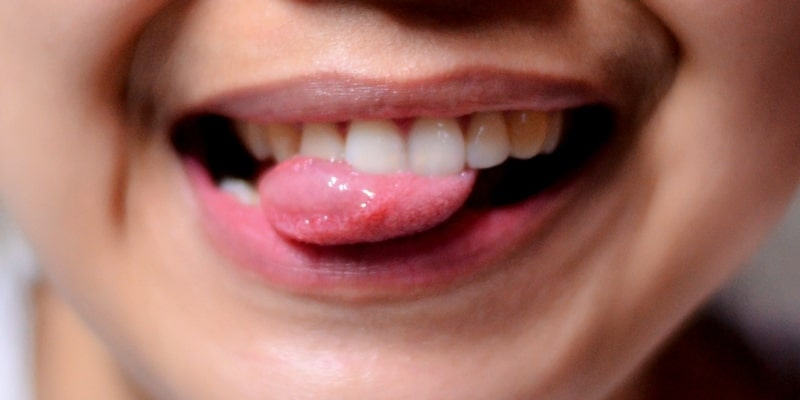 Sering Disepelekan, 5 Tanda ini Menjadi Gejala Awal Kanker Lidah