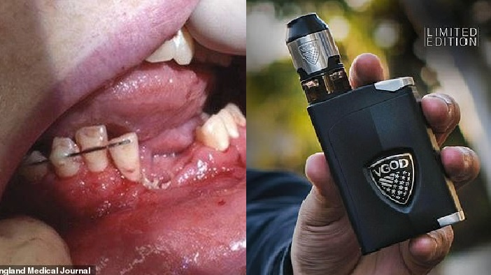 Rokok Elektronik yang Digunakan Remaja Ini Meledak pada Mulutnya hingga  Membuat Gigi Rontok dan Rahang Rusak | Intisari