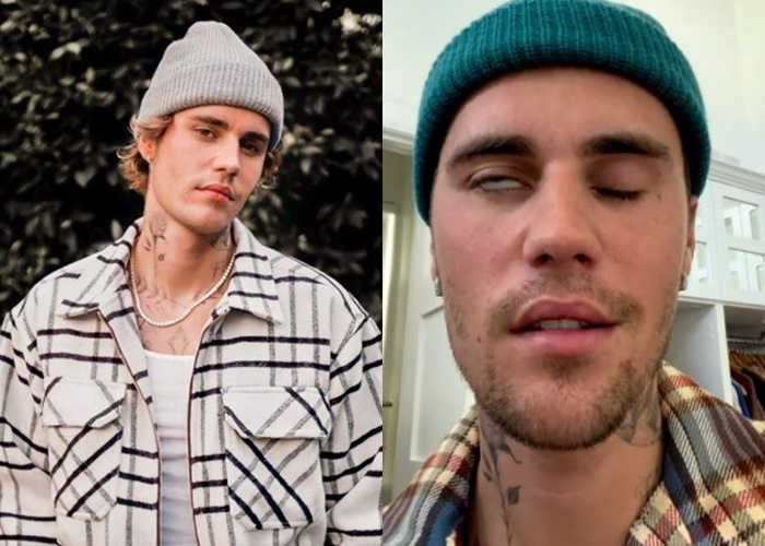 Justin Bieber Alami Ramsay Hunt Syndrome, Ini Bedanya dengan Bell's ...
