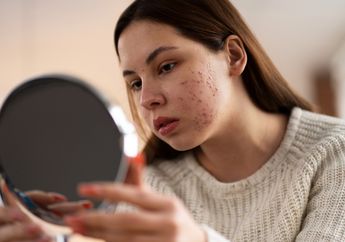 Bisa untuk Semua Gender, 4 Tips Mengempeskan Jerawat dalam Semalam Ini Bisa Membantu Mengatasinya