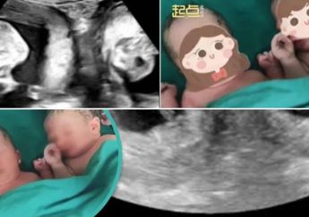 Lahirkan Bayi Kembar dari Dua Rahim Berbeda tapi Satu Tubuh, Wanita Ini Auto Viral hingga Dokter Syok: Sangat Langka