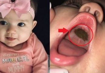 Awalnya Panik, Ibu Ini Justru Malu Setelah Tahu Penyebab Lingkaran Hitam di Langit-langit Mulut Putrinya