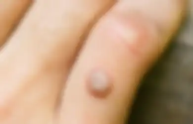 5 Cara Menghilangkan Kutil di Kulit Dengan Mudah dan Tepat