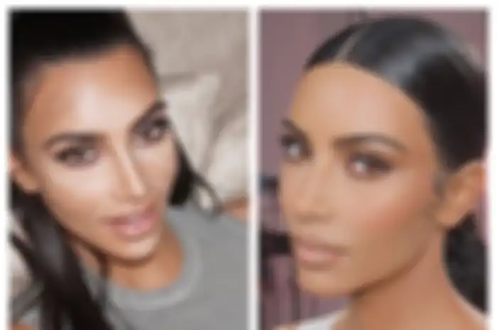 Kim Kardashian menderita penyakit kulit psoriasis