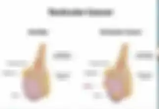Deteksi mandiri tumor testis.