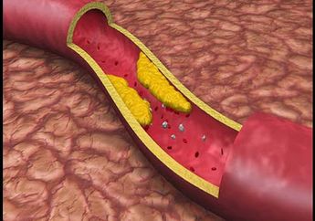 Penyumbatan Pembuluh Darah Bisa Berakibat Fatal, Bersihkan dengan 5 Makanan Ini