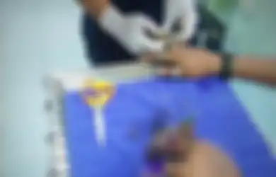 Hati-hati Memakai Aksesoris di Jari, Jika Tak Mau Jari-jari Anda Membusuk Seperti Pria Ini