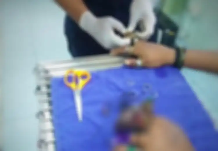Hati-hati Memakai Aksesoris di Jari, Jika Tak Mau Jari-jari Anda Membusuk Seperti Pria Ini