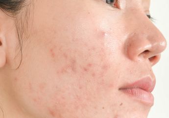 3 Cara Hilangkan Bekas Jerawat Menurut Dermatolog, Gampang Banget!