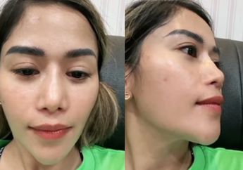Gagal Total! Operasi Plastik 3 Kali, Farida Nurhan PD Pamerkan Kondisi Terkini Lubang Hidungnya yang Bentuknya Bikin Netizen Geleng-geleng Kepala: Gak Menikmati Ngupil
