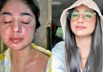 Mengalami Alergi Kulit Saat Terpapar Covid-19, Dewi Perssik: Telanjang Salah, Nggak Telanjang Gatal Semua