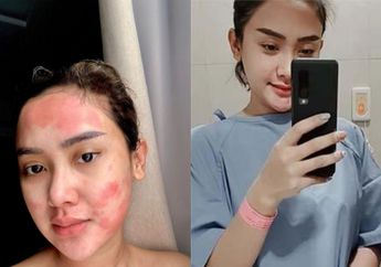 Kulit Mulusnya Penuh Bercak Kemerahan Tiap Hari, Cita Citata Ngaku Harus Dioperasi Gegara Idap Penyakit Ini Selama 5 Tahun Lamanya, Sang Biduan: Berbagai Cara Aku Lakukan...