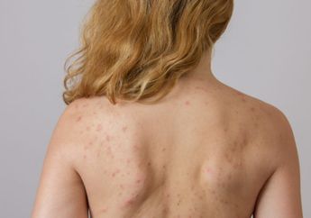 Kenali Penyebab Munculnya Jerawat di Punggung, Atasi dengan 4 Bahan Alami Berikut ini!