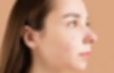 5 Cara Mengatasi Jerawat di Pipi yang Ganggu Penampilan, Bukan Pakai Skincare Mahal!