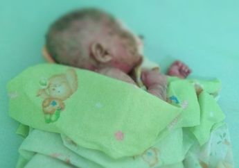 Bermula dari Benjolan di Ketiak, Kulit Bayi Ini Berubah Layaknya Plastik Hingga Membuatnya Menangis Tiap Kali Mengelupas