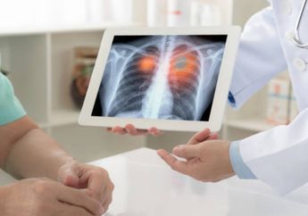 Cegah Kanker Paru Sejak Dini dengan Pemeriksaan Low Dose CT scan Thorax