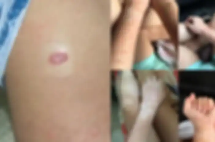 Awalnya hanya bercak merah namun tak disangka ia mengalami hal ini (viral4real)