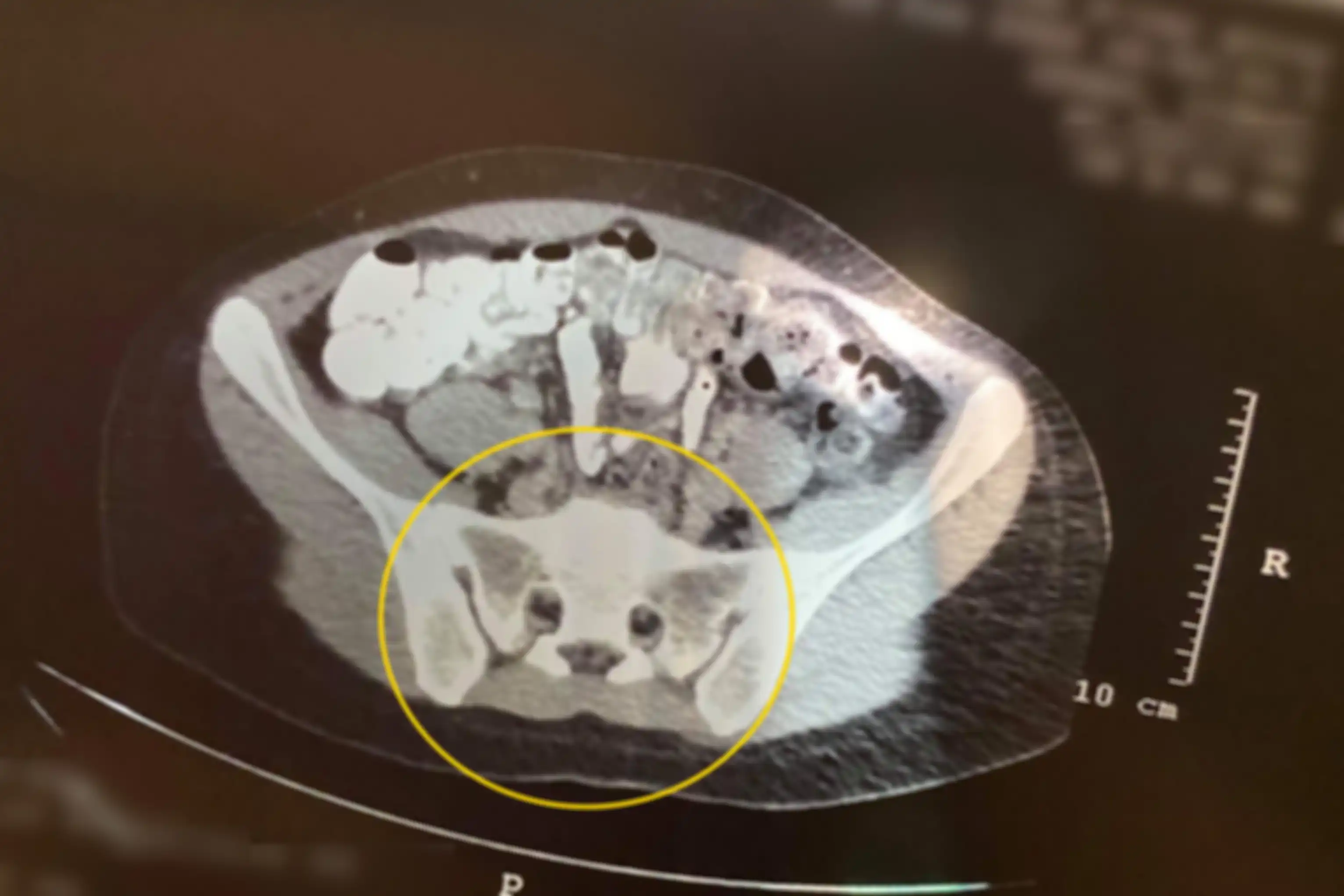 Hasil CT Scan pada bagian panggul Alexandra.