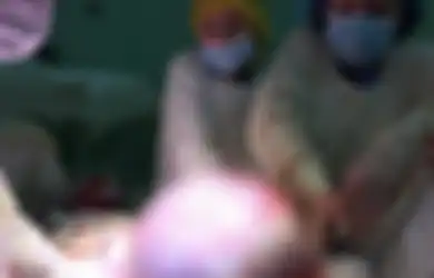 Dokter Bedah Berhasil Angkat Tumor Seukuran Bola Pantai yang Beratnya 25 Kg dari Ovarium, yang Bikin Wanita Ini Sulit Bernapas