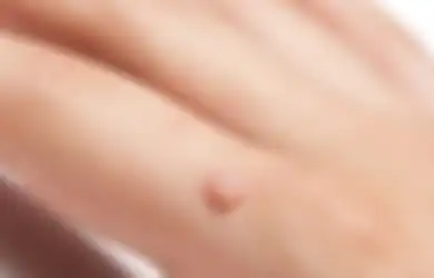 Hilangkan Kutil Cukup Pakai 5 Bahan Alami Ini. Enggak Minder Lagi!