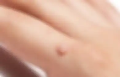Hilangkan Kutil Cukup Pakai 5 Bahan Alami Ini. Enggak Minder Lagi!